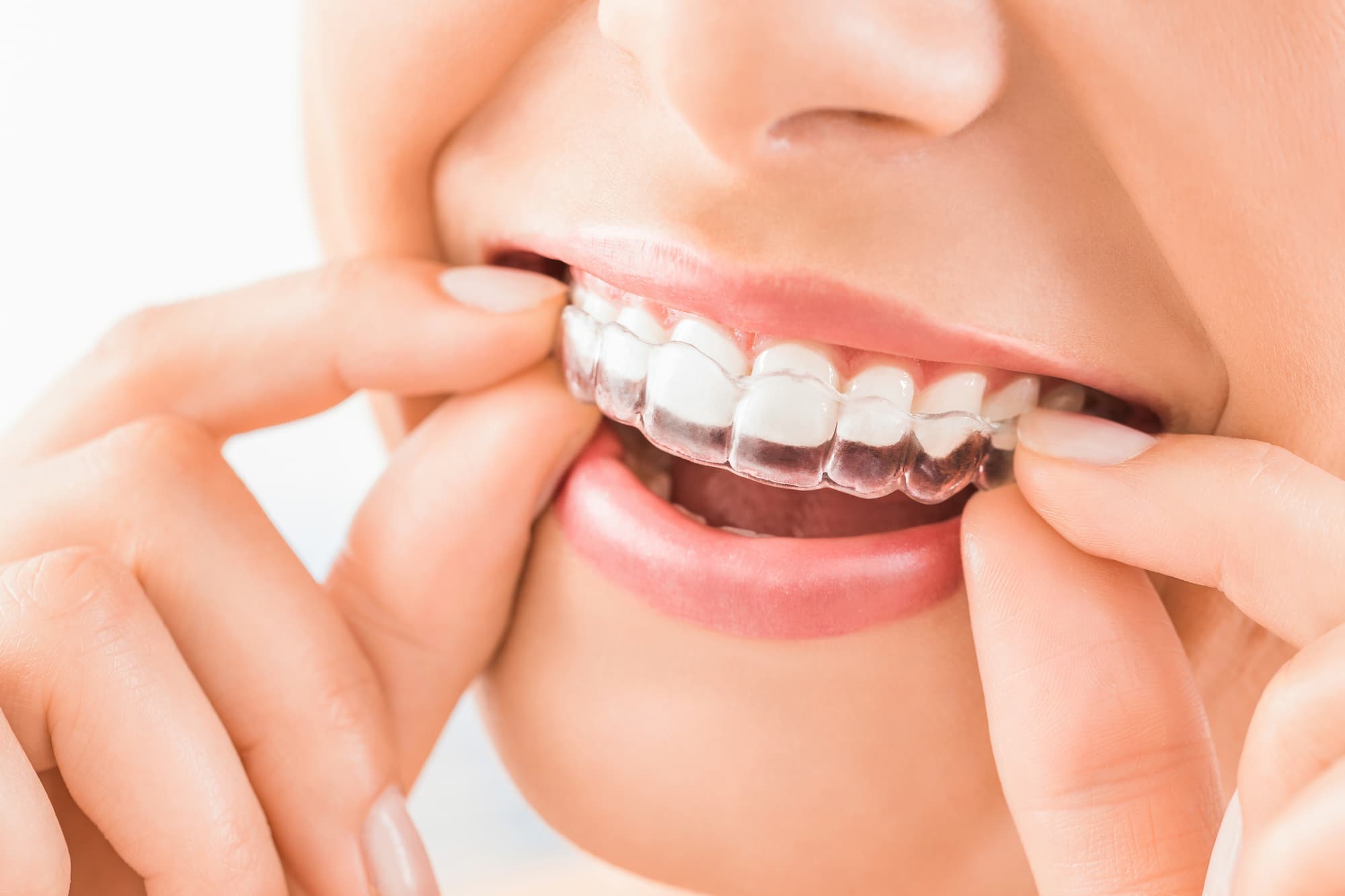 Zahnkorrekturen mit Invisalign
